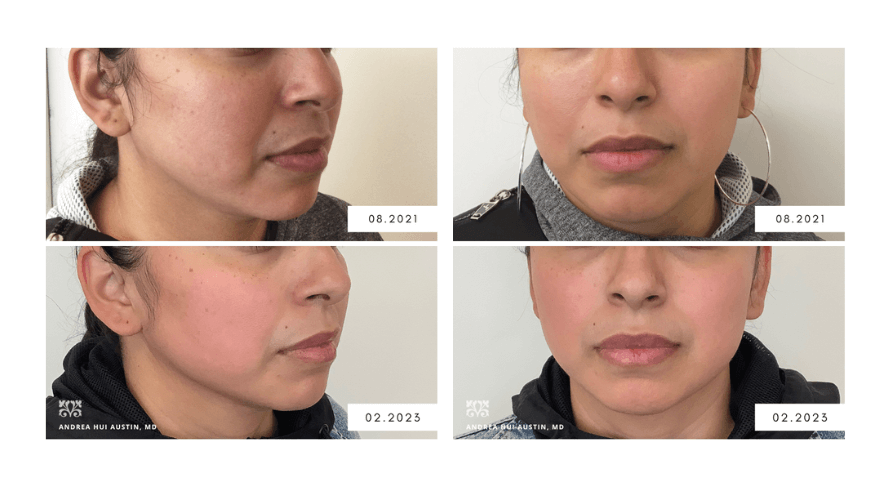 Buccal Fat Removal